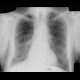 Lung tumour, hilar lymphadenopathy, first radiograph: X-ray - Plain radiograph
